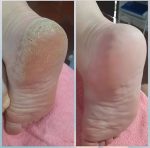 اسپری لایه بردار و رفع ترک پا راکو