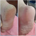 اسپری لایه بردار و رفع ترک پا راکو