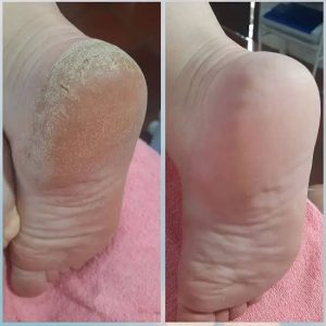 اسپری لایه بردار و رفع ترک پا راکو